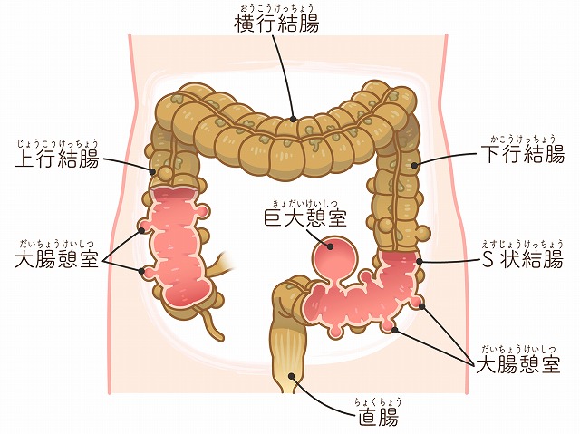 大腸憩室症