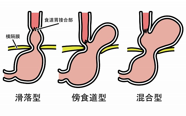 食道裂孔ヘルニアについて